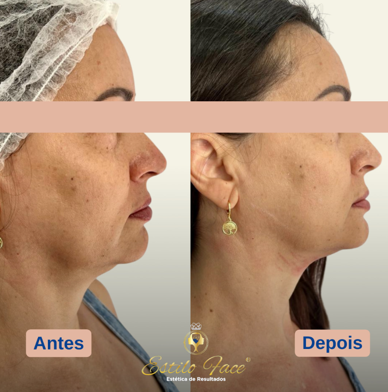 Antes e depois — Renata S., 48 anos